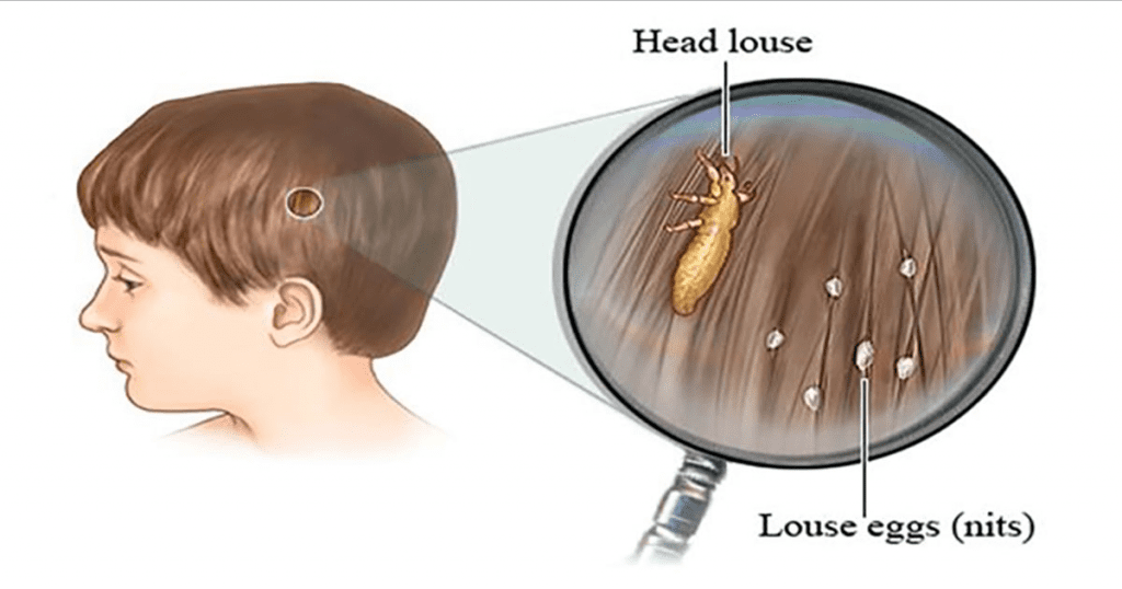 head lice treatment