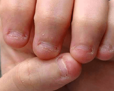 11 Shocking Facts That Might Help You To Stop Biting Your Nails