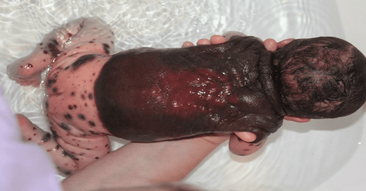Mom Was Shocked To See Her Newborn Covered In Dark Bloody Spots