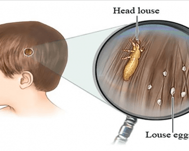 Here’s How You Can Get Rid Of Head Lice