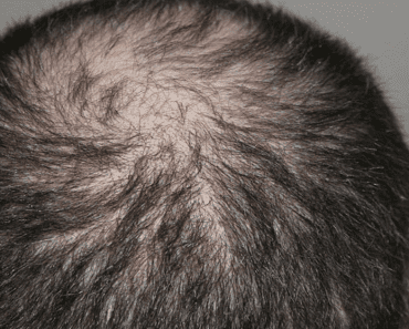 People Who Suffer From Hair Loss Can Eat These 9 Foods To Reverse The Process
