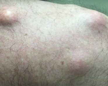 He Said He Had A ‘Golf Ball’ Under His Skin, Then The Doctor Cuts Into Him