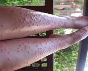 If Mosquitos Used To Ruin Your Summer You Might Want To See This