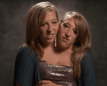 The Story of Elementary School Teachers Conjoined Twins Abby And Brittany